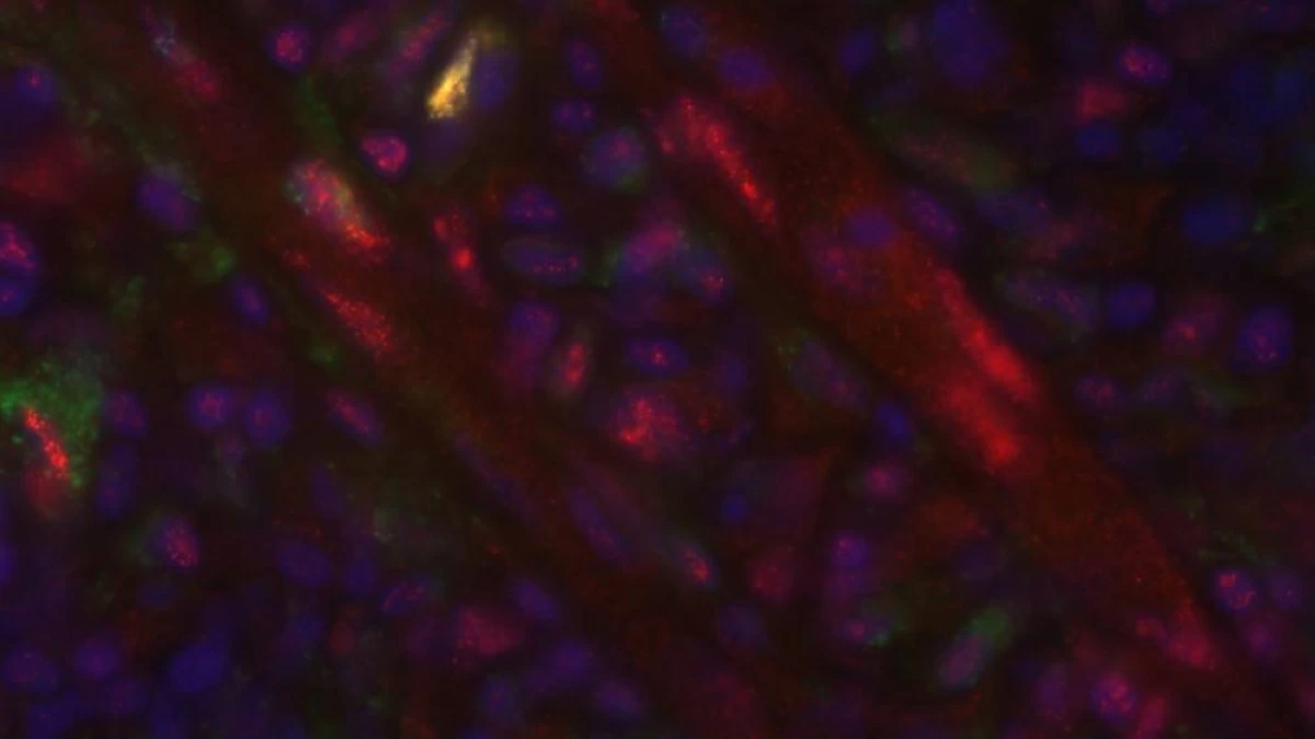 صورة مجهرية لجلد مريض سكري مصاب بعد 14 يوماً من وضع الضمادة