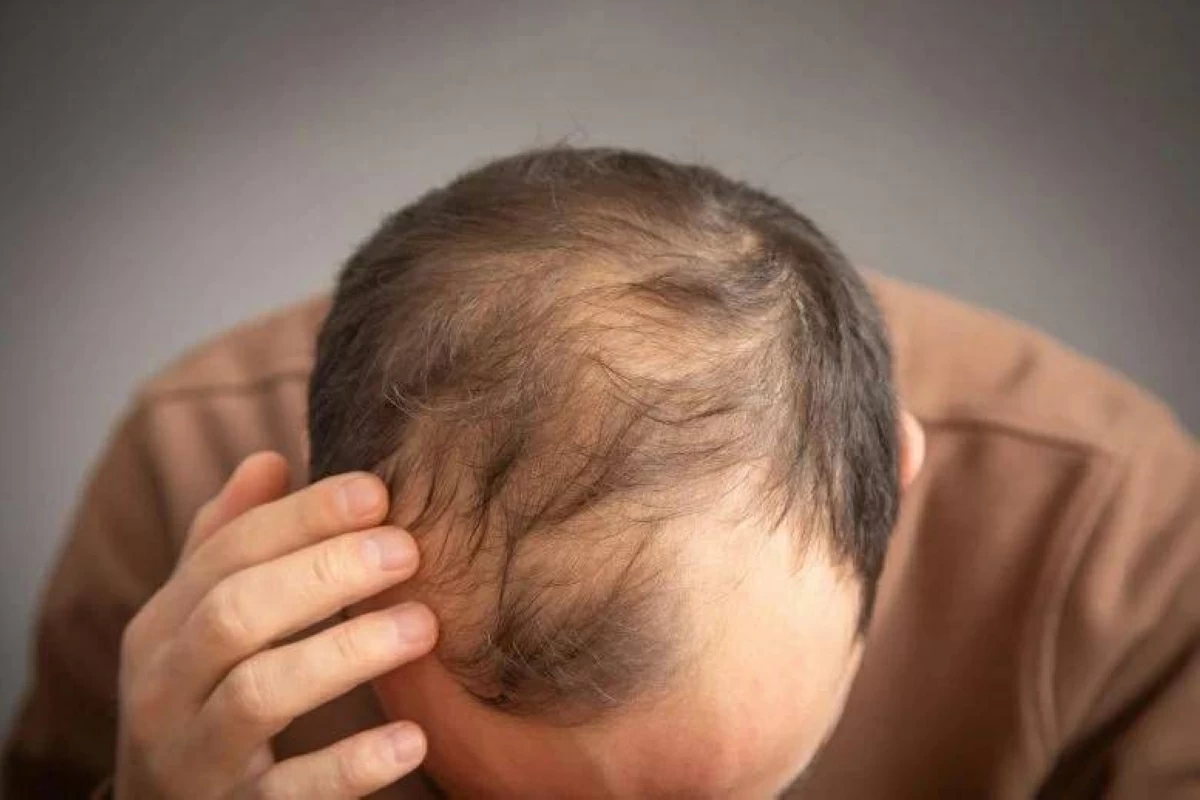 بروتين يحمي بصيلات الشعر يتسبب في تساقطه