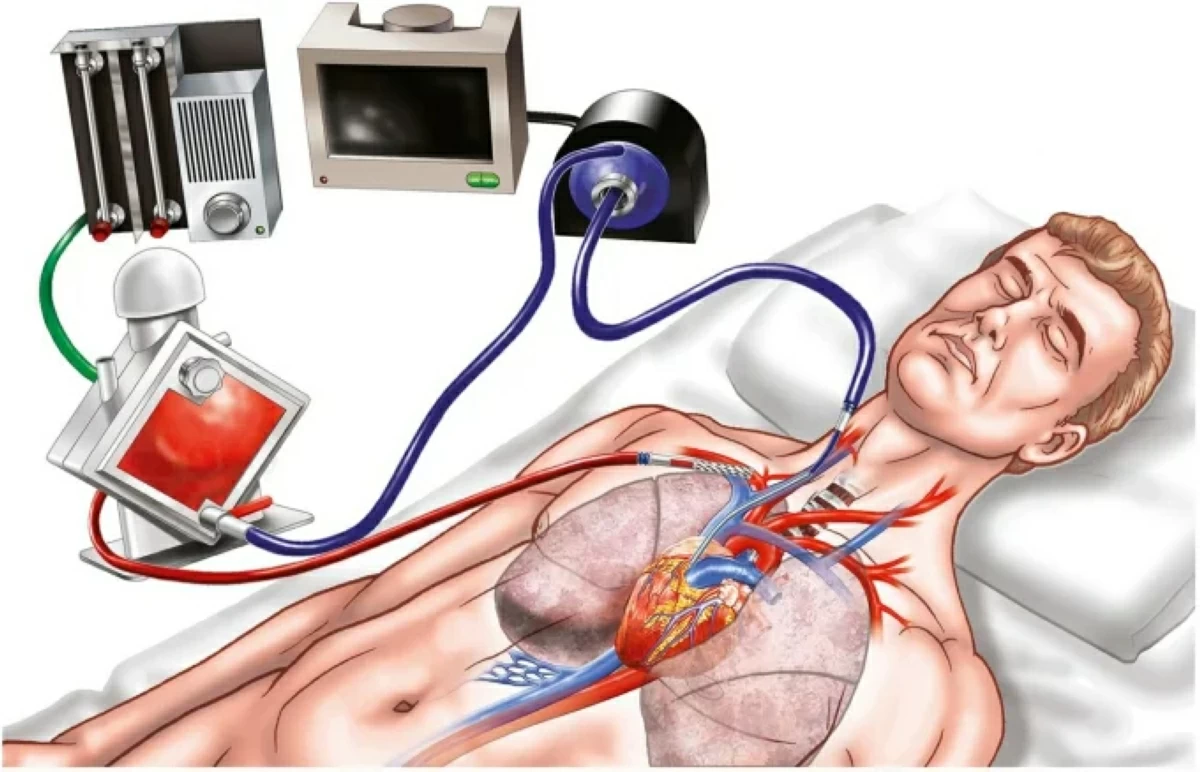 عاجل| يعود للحياة بعد 40 ساعة من توقف قلبه 