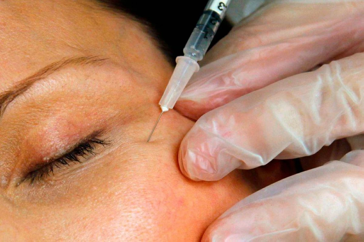 علاج تجميلي من دهون الموتى.. والحقنة بـ 100 ألف دولار