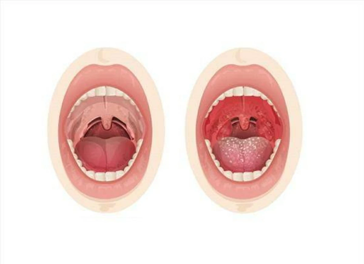 استئصال اللوزتين يهدد بخطر التصلب المتعدد