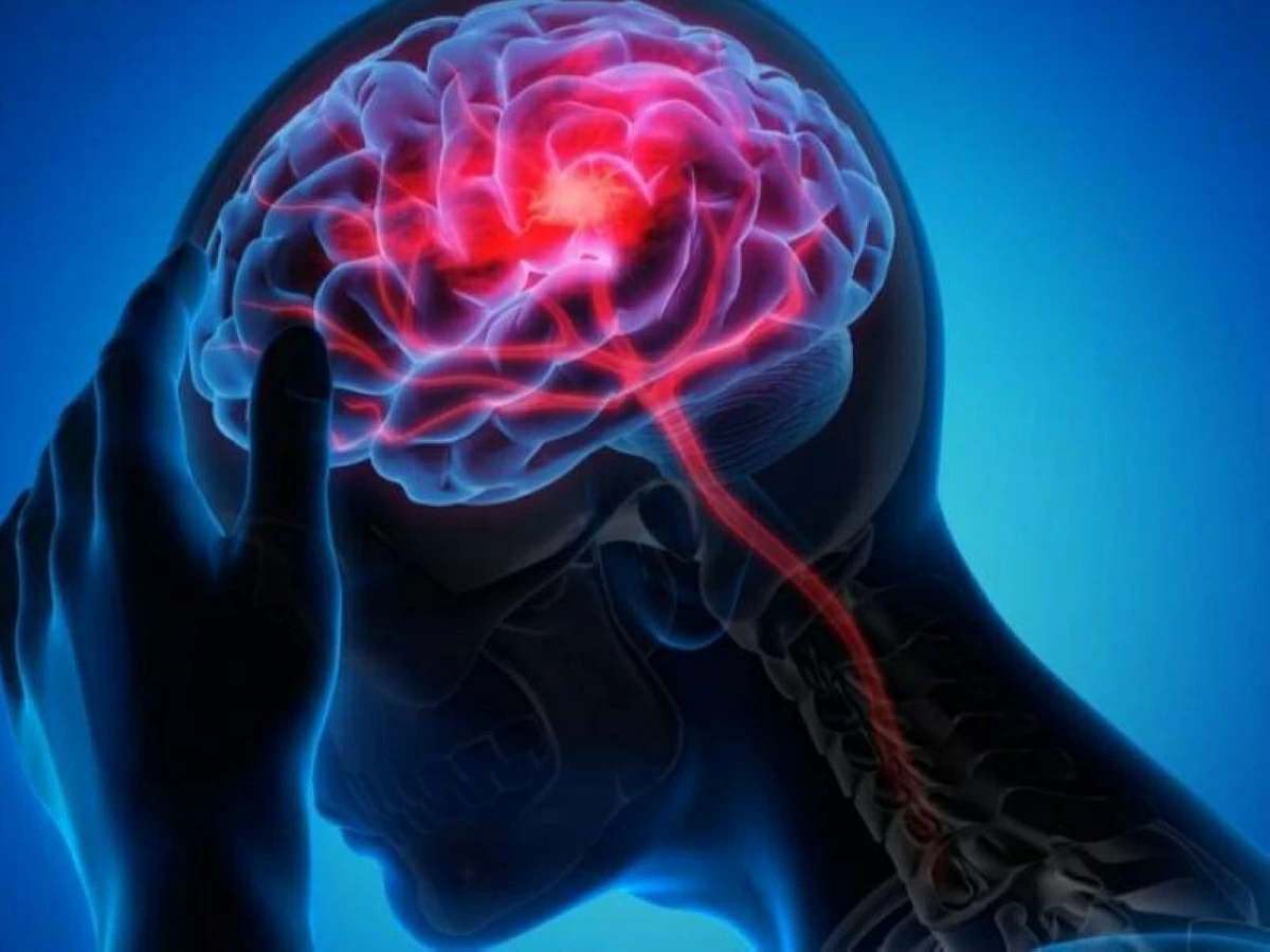 «خريطة دماغية» لعلاج الصرع بدقة