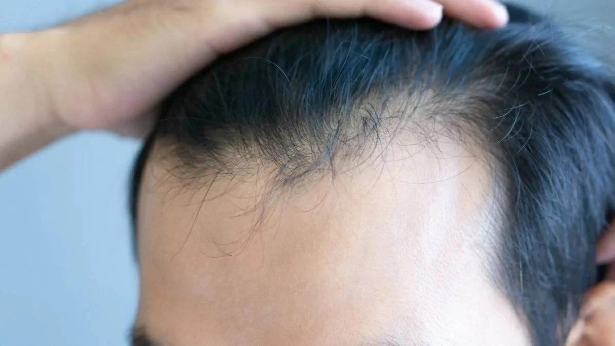 أدوية التخسيس تزيد مخاطر تساقط الشعر