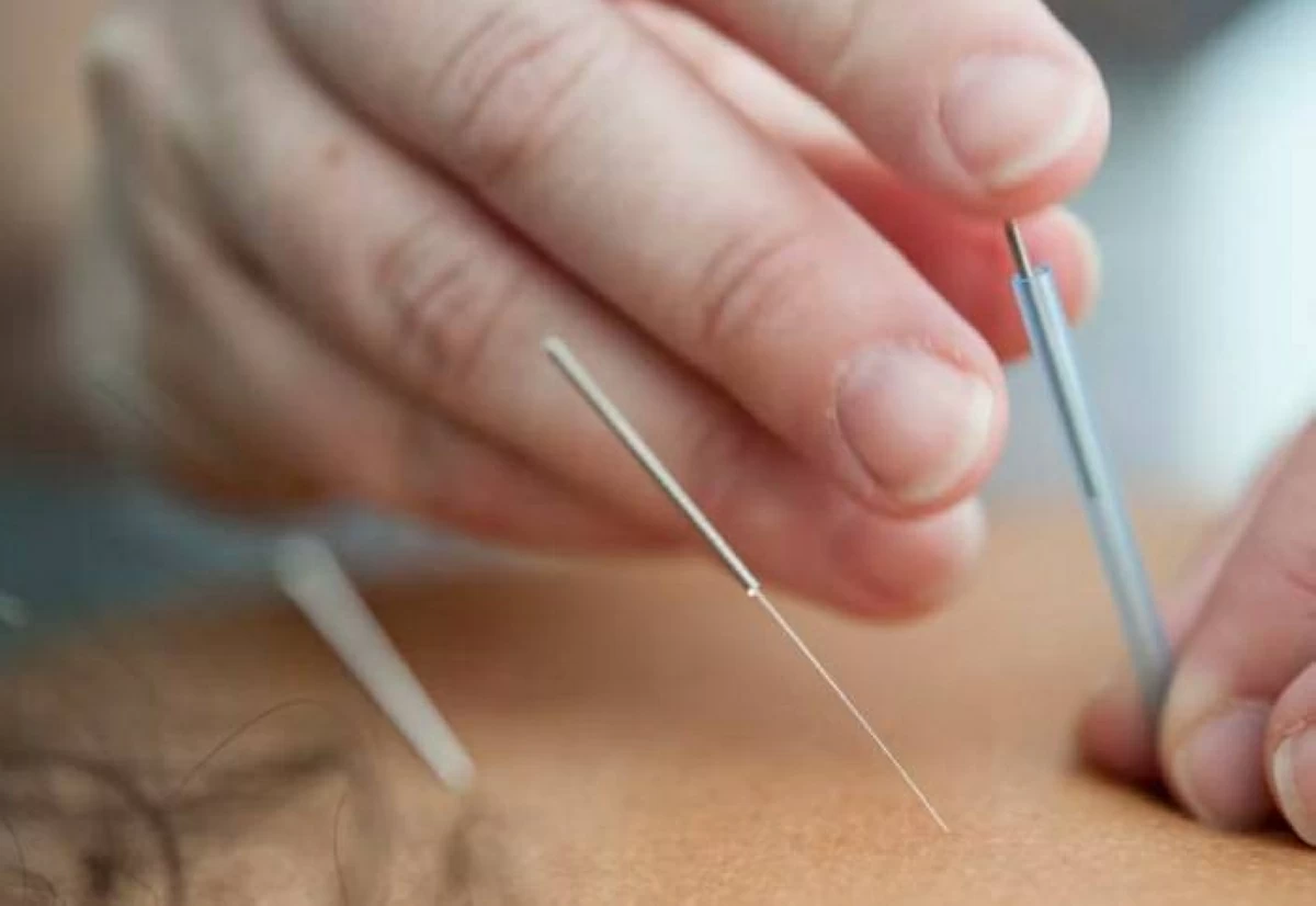 الوخز بالإبر يسبب كارثة بقدم امرأة