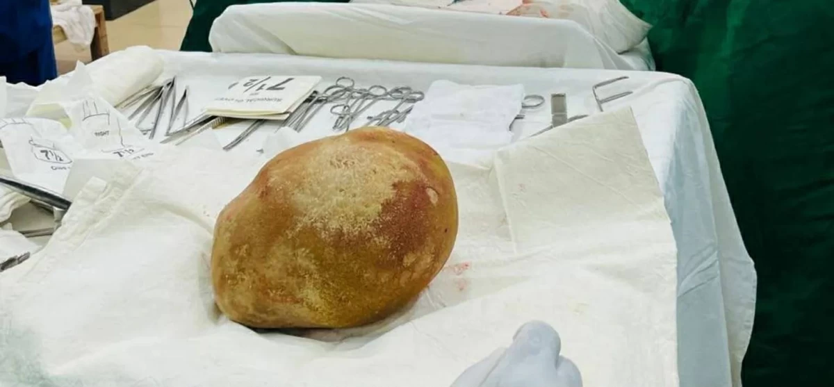 بحجم طفل رضيع.. استخراج حصوة تزن 3.1 كجم من رجل في سريلانكا
