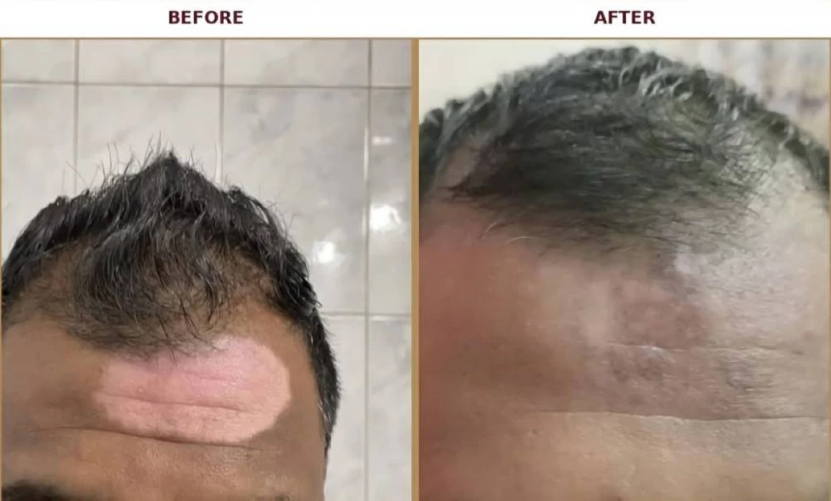 أطباء مصريون ينجحون في علاج البهاق بالخلايا الصبغية