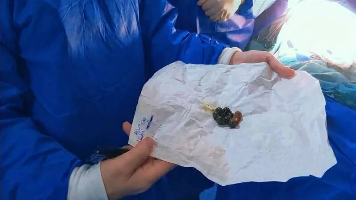 إنقاذ طفلة ابتلعت 15 مغناطيساً في مصر.. كيف نجح الأطباء دون فتح الأمعاء؟