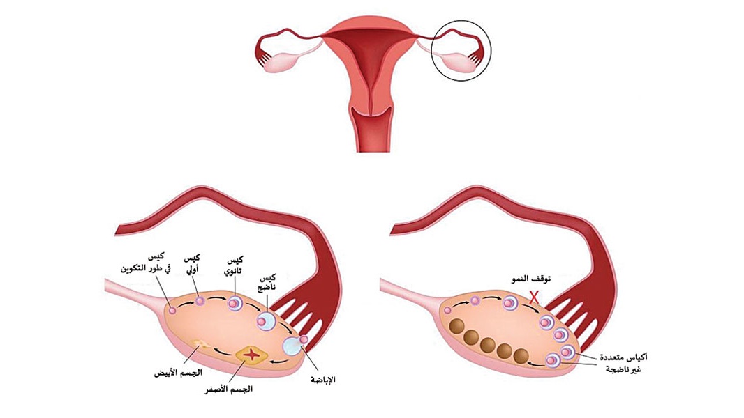 Поликистоз яичников при беременности. Поликистозные фолликулы. Поликистоз яичников и беременность. Синдром поликистозных яичников менструация.