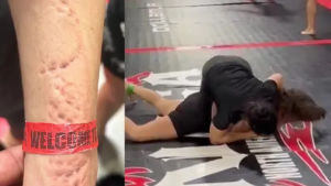 صورة الذراع بعد النزال