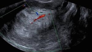 سرطان المبيض باللون الأحمر