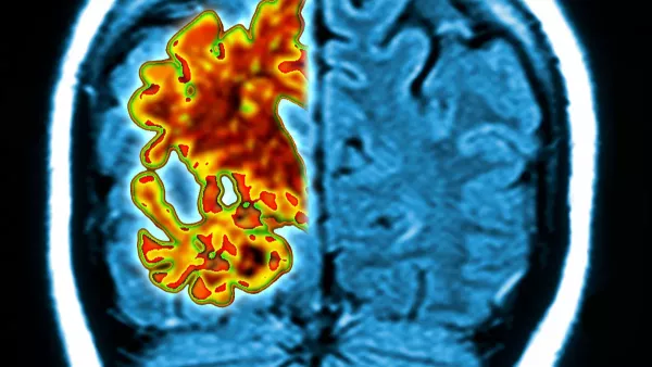 اختبار يتنبأ بـ «ألزهايمر» قبل ظهور الأعراض بسنوات