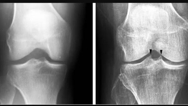 تعديل أسلوب المشي يخفف آلام التهاب المفاصل