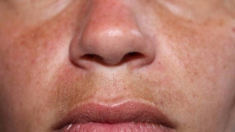 مشاكل البشرة أثناء الحمل طبيعية ويسهل علاجها | صحيفة الخليج