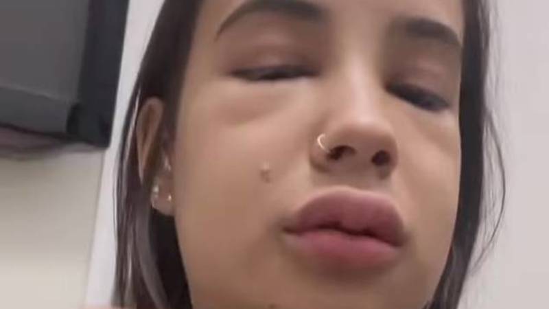 هوس التجميل يتسبب بكارثة لفتاة برازيلية