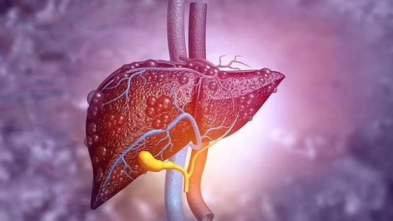 علاج تليف الكبد بـ«الخلايا البلعمية»