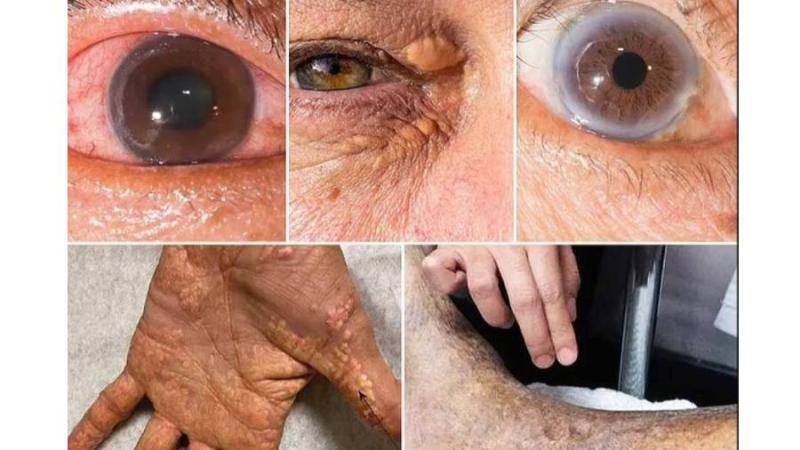 علامات لارتفاع الكوليسترول