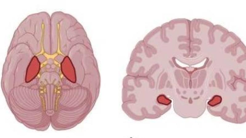 الدماغ المريض على اليمين والسليم على اليسار