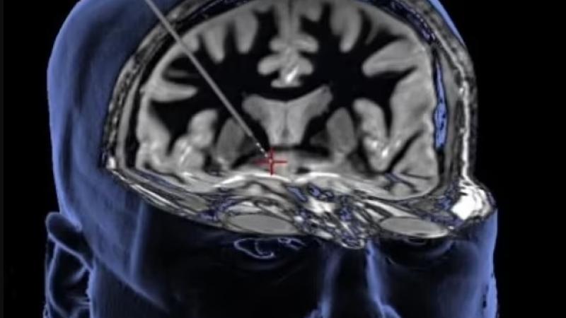 المنطقة المستهدفة بالدماغ