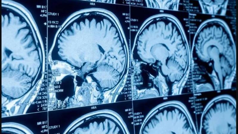 أداة ذكاء اصطناعي تكشف 64% من التشوهات الدماغية