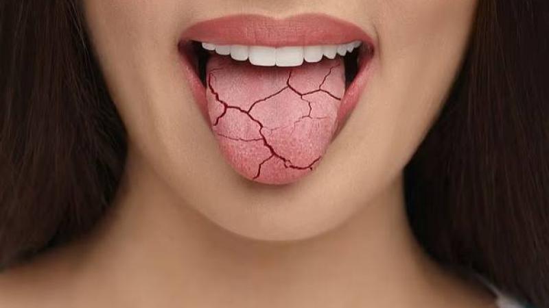 جل للتجاعيد يمهد الطريق لترطيب جفاف الفم المزمن