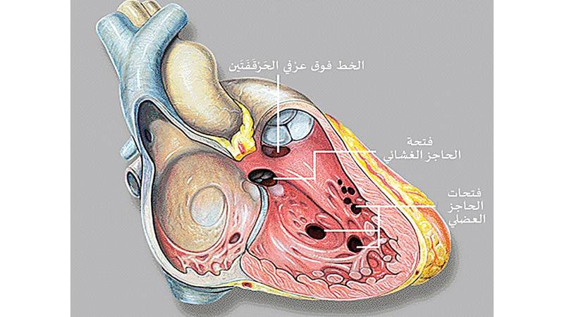 العيوب الخلقية في الحاجز البطيني عند الأطفال صحيفة الخليج
