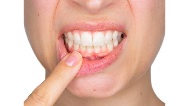 انحسار اللثة عن السن هو بداية المشكلة