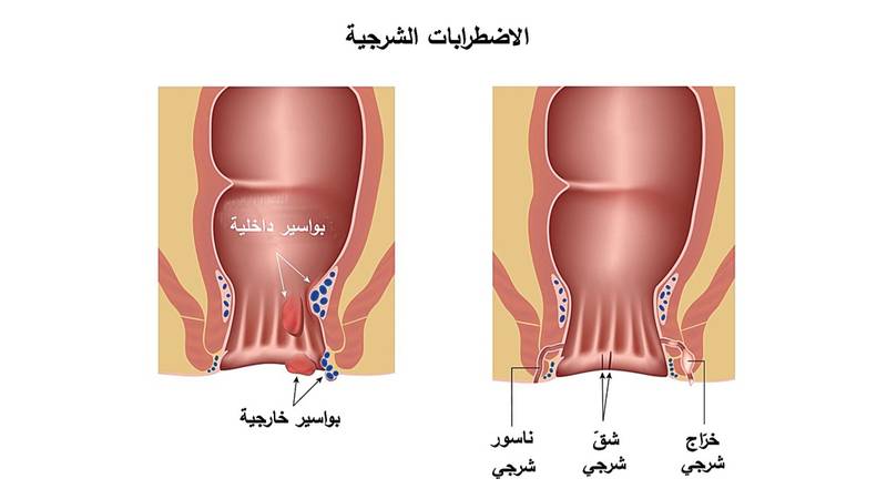 صحيفة خليجية الناسور الشرجي