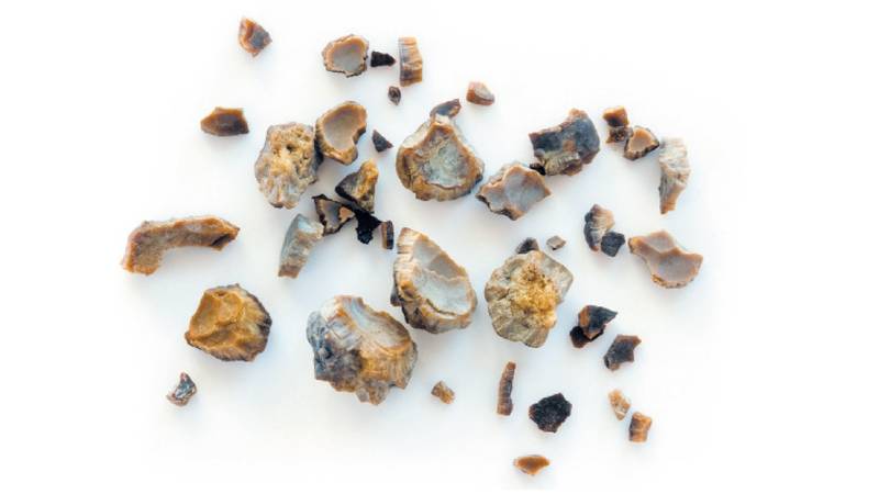 حصوات الكلى هي ألم يمكن تجنبه