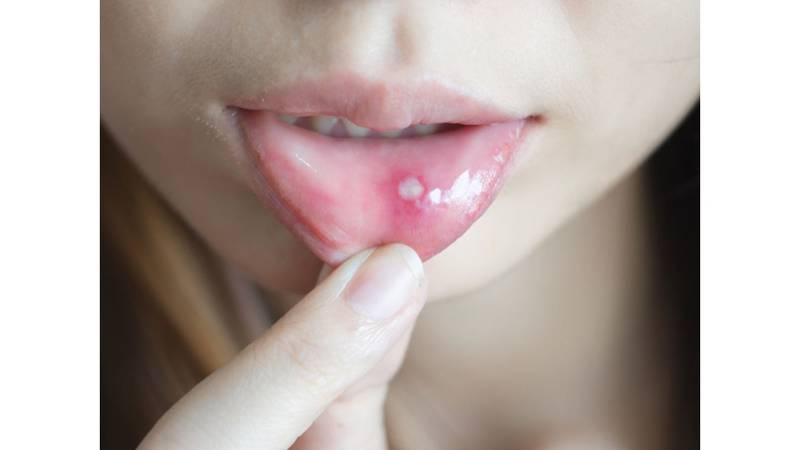 الحبوب وتقرحات الفم واللسان من أعراض الأمراض المعدية