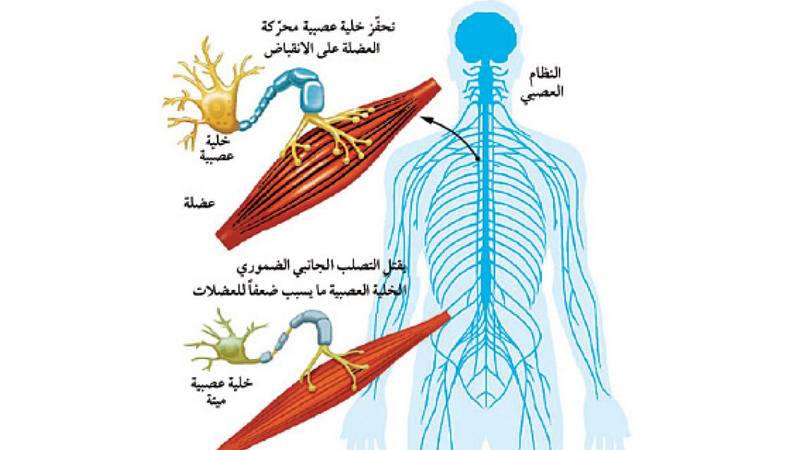 للدسك يهدد بالشلل ولا يؤثر على المخ إليك كل ما تريد معرف الكونسلتو