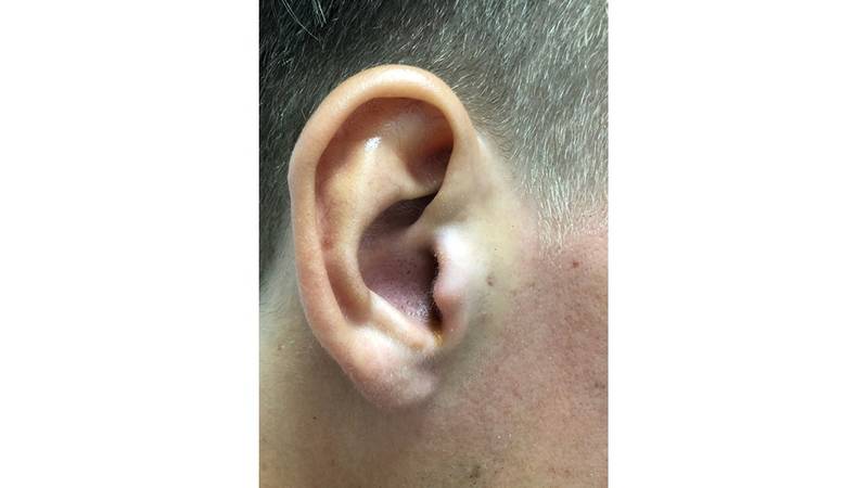إزعاج مشرق تكبير  التهاب الأذن الخارجية يسبب ثقب الطبلة | صحيفة الخليج