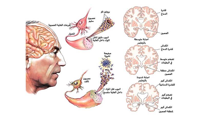 الزهايمر أسبابه وأعراضه وعلاجه صحيفة الخليج