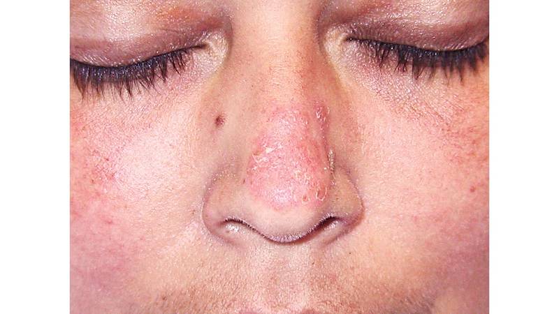 الذئبة الحمراء مرض ذاتي المناعة صحيفة الخليج