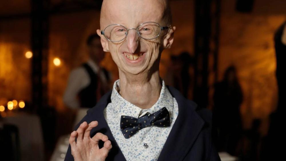 وفاة المصاب بالشيخوخة المبكرة الأطول عمراً عن 28 عاماً - صورة 2 6348553.jpeg