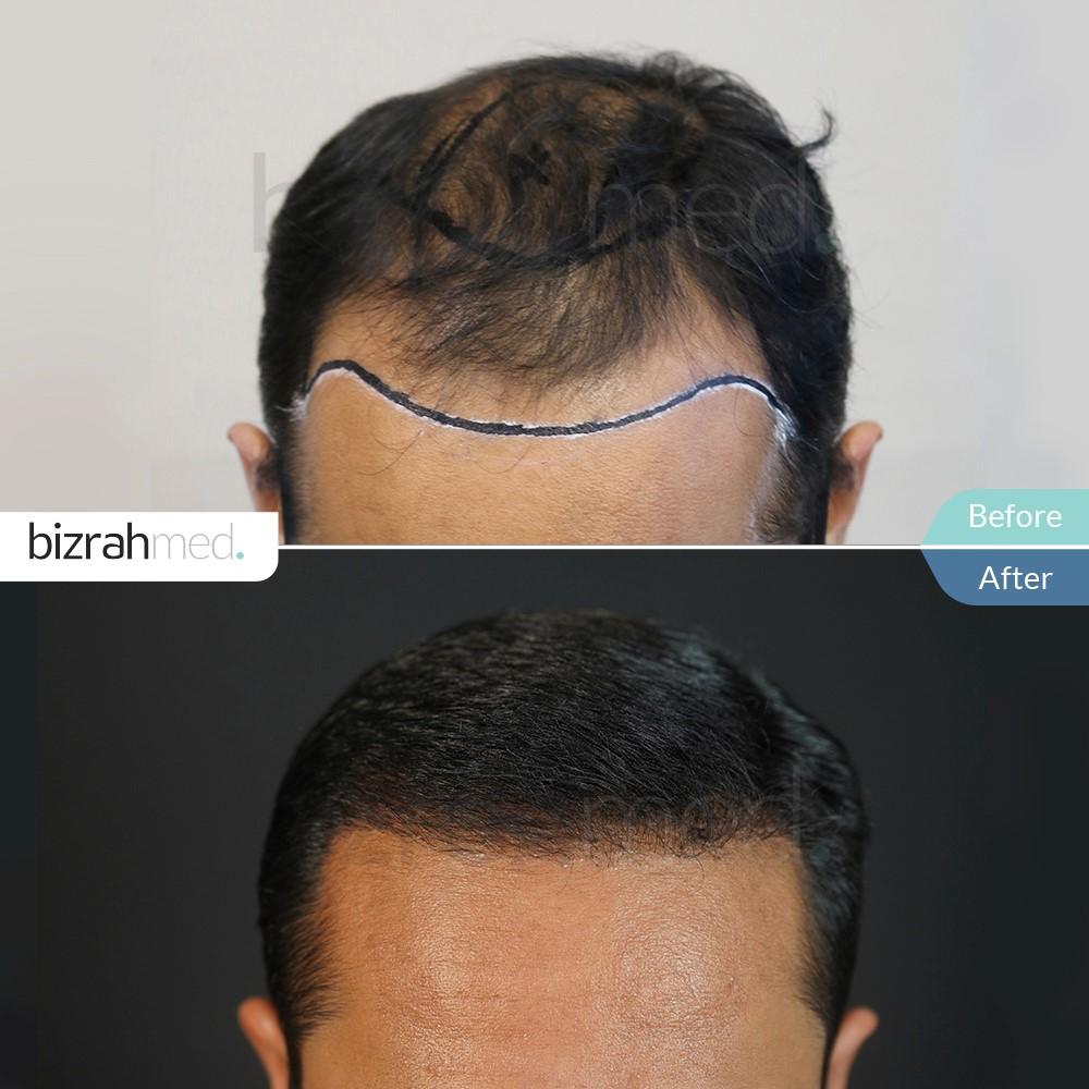زراعة الشعر في السعودية الخبر