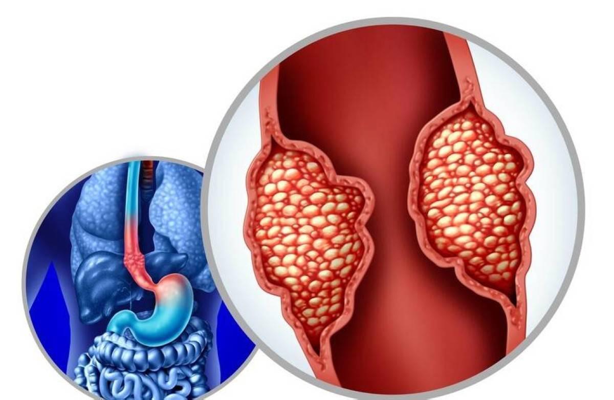 سرطان المريء