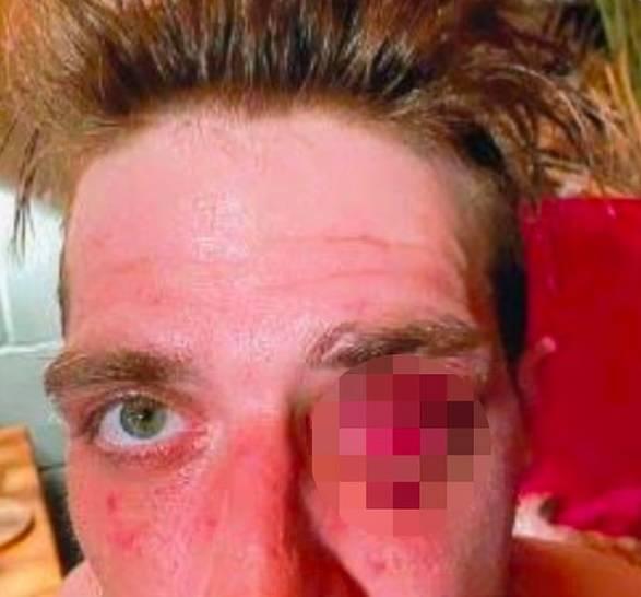 عاجل| 4 ملايين دولار لأمريكي فقد بصره بلكمة شرطي 