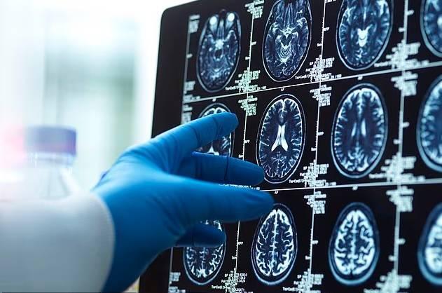 دراسة تكشف: حجم الرأس ومستوى التعليم مرتبطان بالخرف #صحيفة_الخليج 