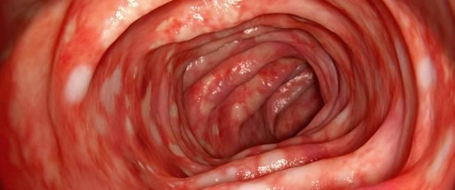 جين يحمي الأمعاء من الالتهابات #صحيفة_الخليج 