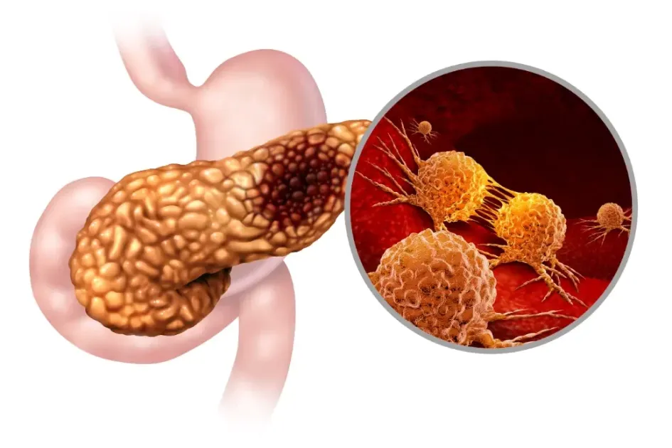 عاجل| ذكاء اصطناعي يحدد علاج سرطان البنكرياس 