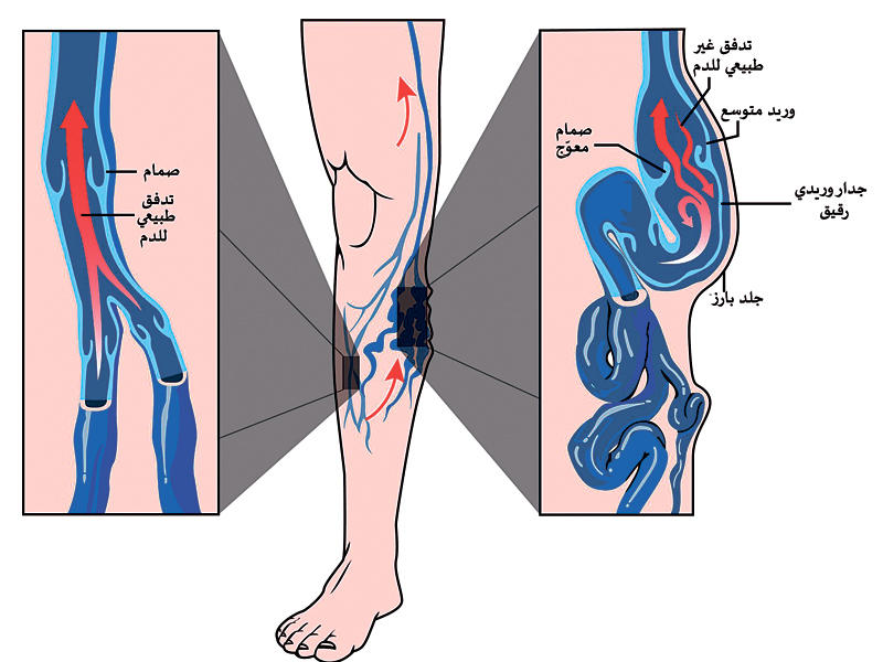اعراض الدوالي عند الرجال