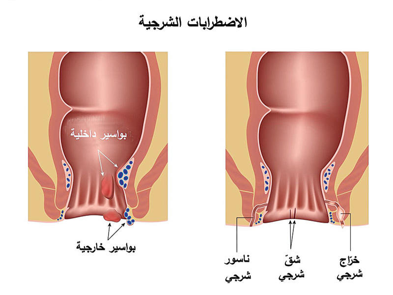 علاج الناسور بدون جراحة