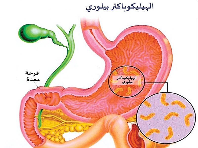 Helicobacter pylori diarrea y estreñimiento