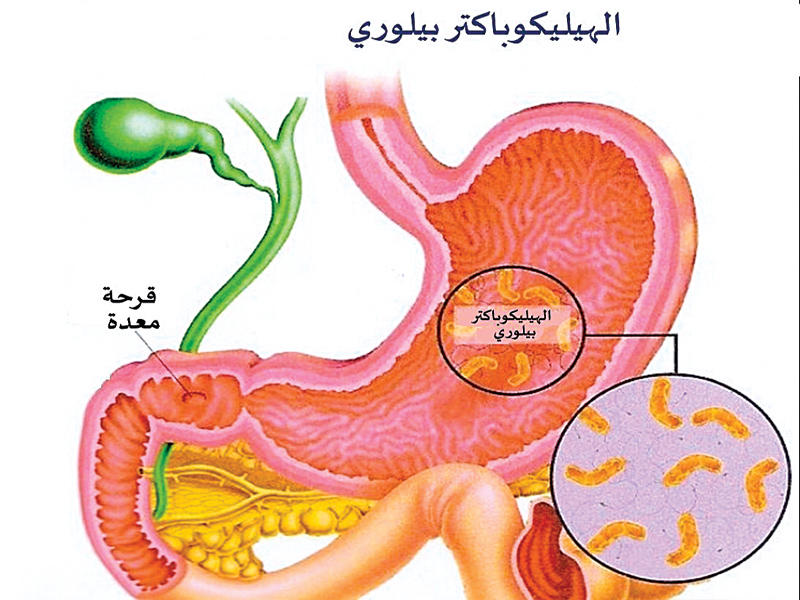 جرثومة ماهي المعدة اعراض الفرق بين