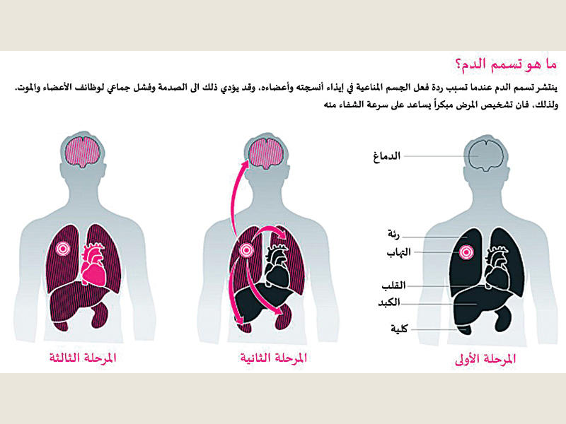 كيف تتشابه أعراض تسمم الدم ونزلات البرد؟
