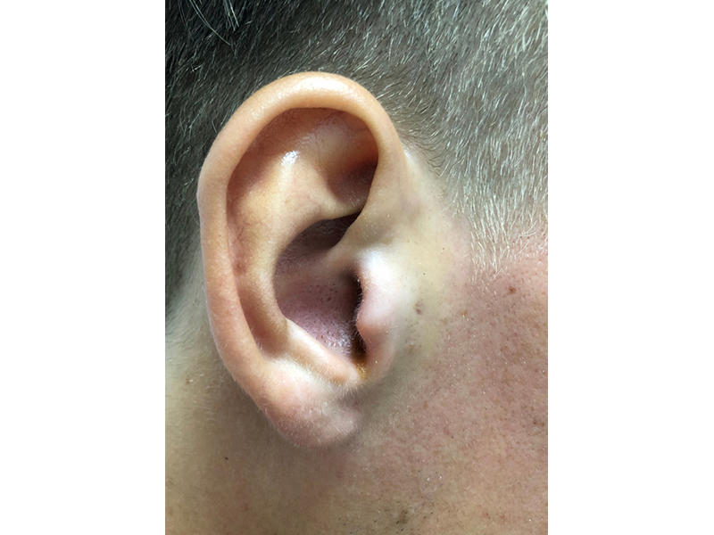 يسبب التهاب الأذن الخارجية ثقبًا في طبلة الأذن