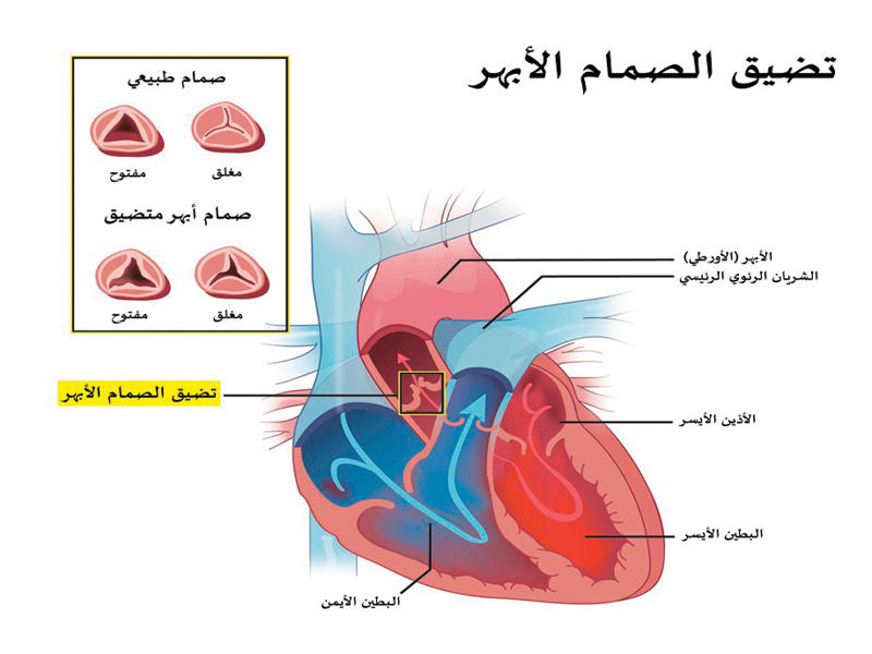 الابهر اعراض أعراض الأبهر