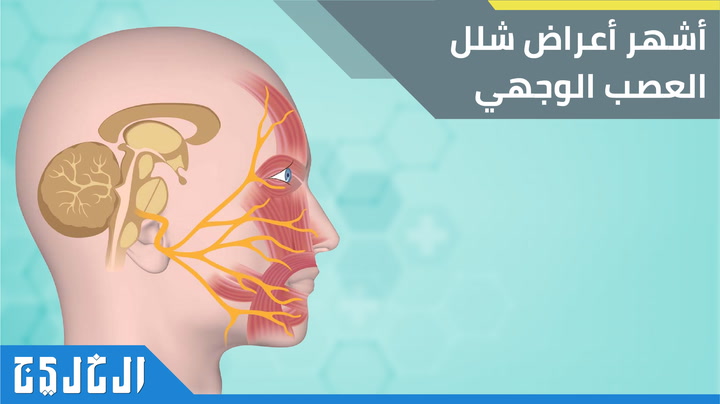 شلل العصب الوجهي الالتهابات الفيروسية بؤرة الإصابة صحيفة الخليج