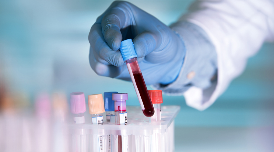 مراقبة «هيدروكسي كلوروكوين» بالدم تنبئ بالجلطة