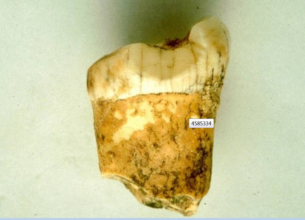 السن المكتشفة